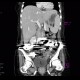 Barium, beam hardening artifacts: CT - Computed tomography